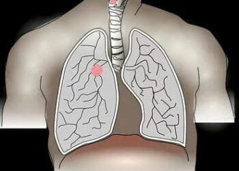 3 bahan alami mencegah gejala kanker paru-paru