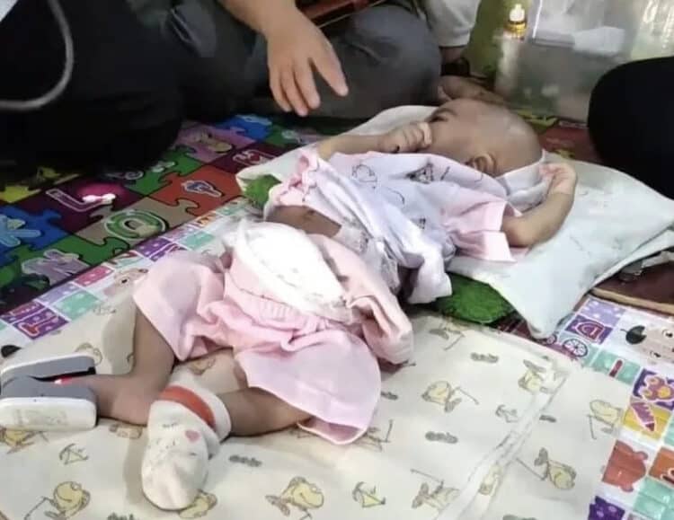 Kondisi bayi yang tak memiliki anus, sedang terbaring di kediamannya, Rabu (31/8/2022). (ISTIMEWA)