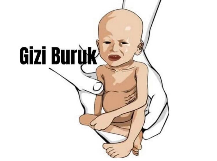 balita-gizi-buruk