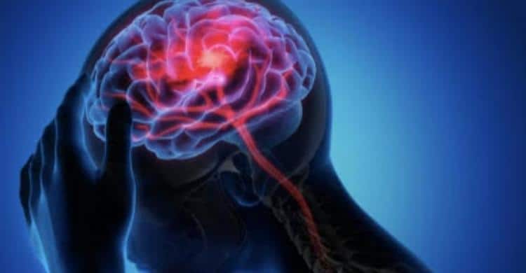 8 Penyebab, Tanda-tanda, Penanganan dan Pencegahan Pendarahan Otak