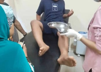 Seorang warga korban serangan Lutung (Spesies Monyet), dirawat di Puskesmas. (ISTIMEWA)