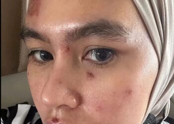 Wajah Dan Lidah Melepuh, Begini Penjelasan Kartika Putri Ungkap Penyebabnya