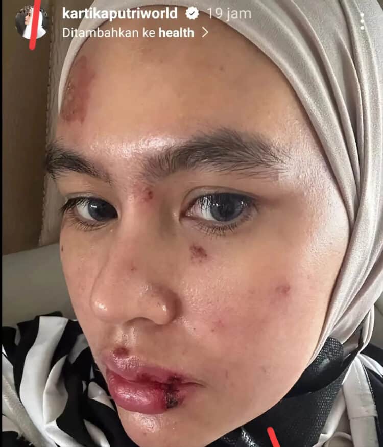 Wajah Dan Lidah Melepuh, Begini Penjelasan Kartika Putri Ungkap Penyebabnya