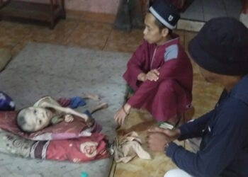 Seorang Balita Derita Gizi Buruk dan Hidrosefalus