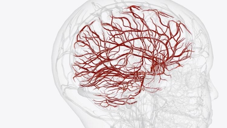 Digital Subtraction Angiography, Bantu Dokter Deteksi Jalur Macet di Pembuluh Darah Otak