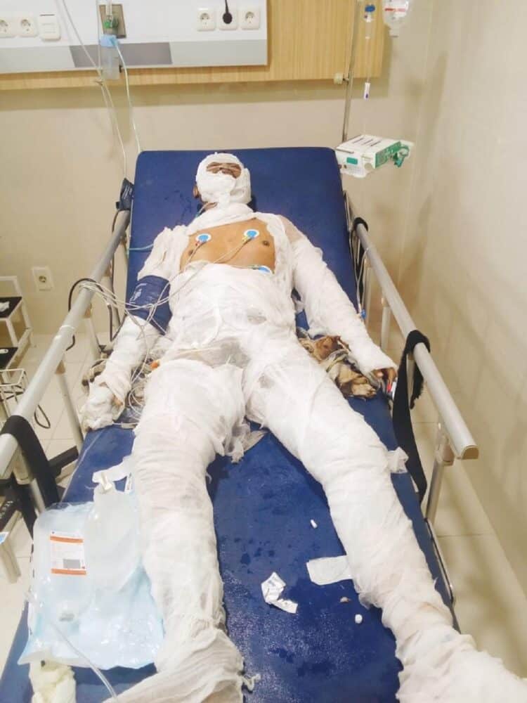 Korban Ledakan Pondok Cabe Ilir Meninggal Dunia Setelah Dirawat Seminggu