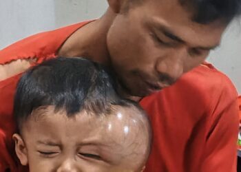 Farhan (4), warga Kampung Simpang RT 001 RW 003, Desa Banyuasih, Kecamatan Cigeulis, Kabupaten Pandeglang, menderita tumor ganas dibagian wajah sebelah kiri, Minggu (29/3/2026). (MARDIANA/SATELITNEWS.COM)