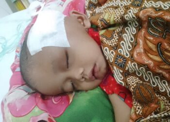 DI BIOPSI – Farhan (3) penderita tumor ganas dibagian wajah, usai biopsi, di RS Dharmais, Jakarta, Rabu (3/6/2026). (ISTIMEWA)